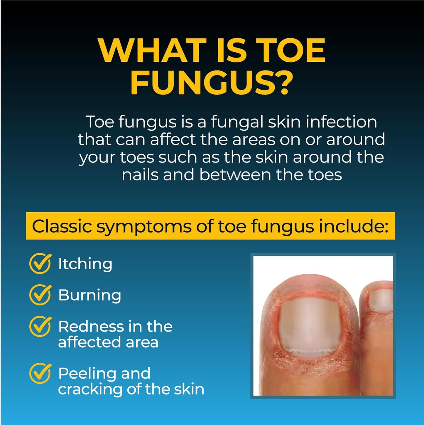 Fungi-Nail Solución líquida antifúngica, mata los hongos y pie de atleta con tolnafato clínicamente probado para curar y prevenir infecciones fúngicas  - 30ml .